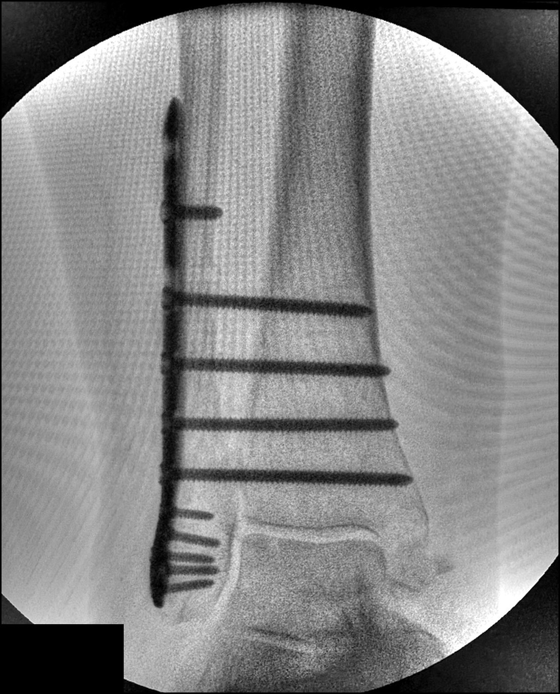 Intra-operative image of a fixed ankle fracture: fibular plate and screws