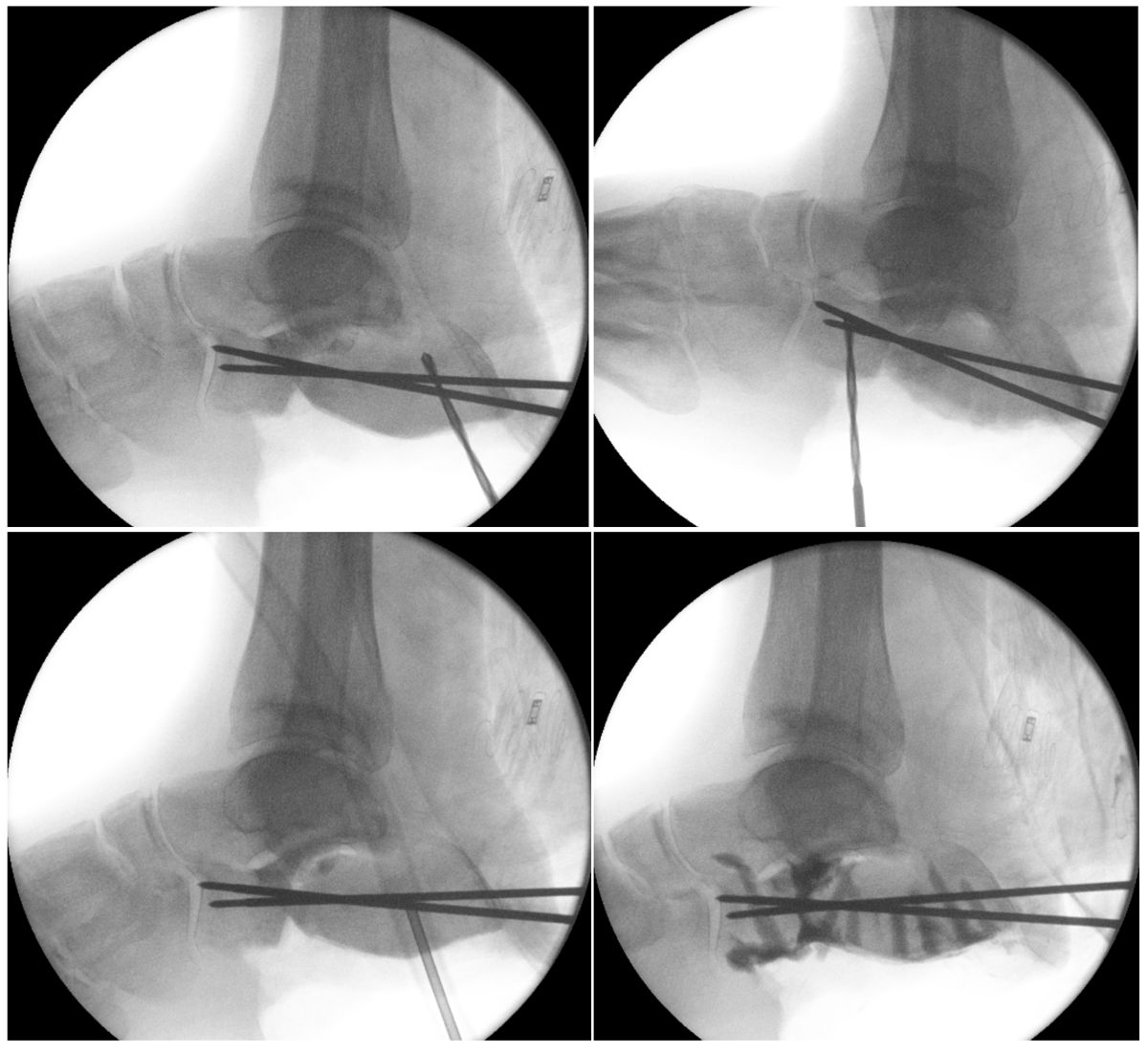 Bone biopsy under X-ray guidance