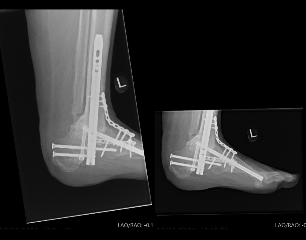 X-rays after definitive correction and fixation