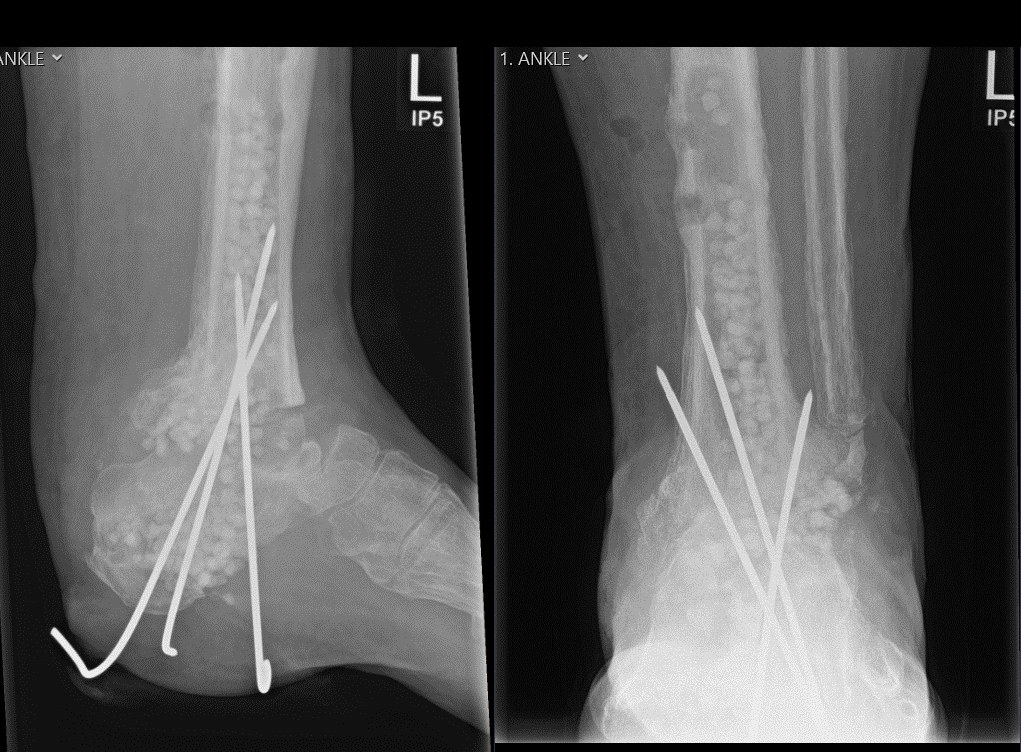 X-rays after debridement and temporary stabilisation