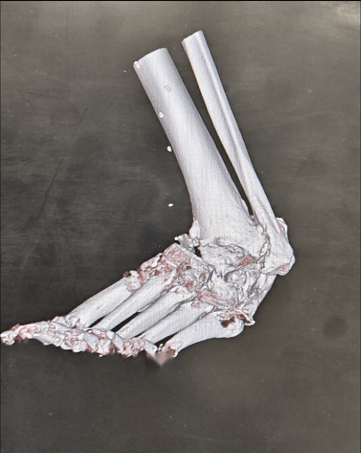 3D CT reconstruction of a Charcot ankle and hindfoot