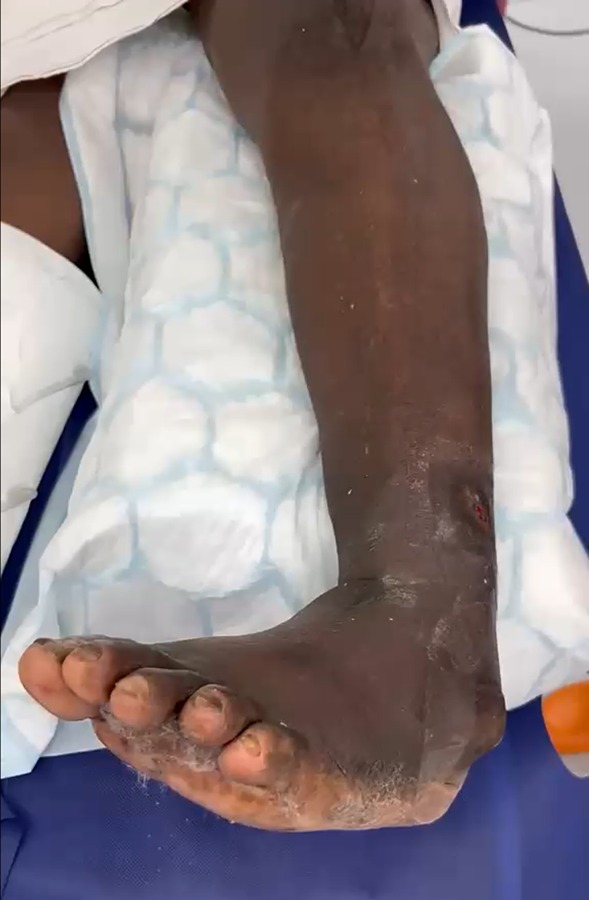 Charcot foot with a collapsed arch and skin breakdown over the midfoot