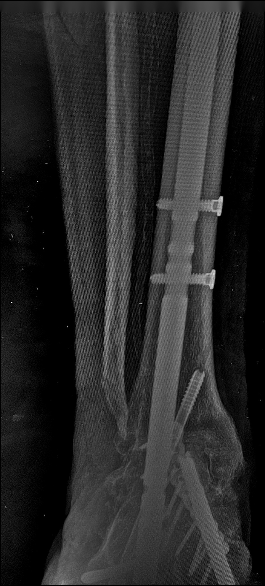 Weight-bearing AP X-ray after Charcot reconstruction