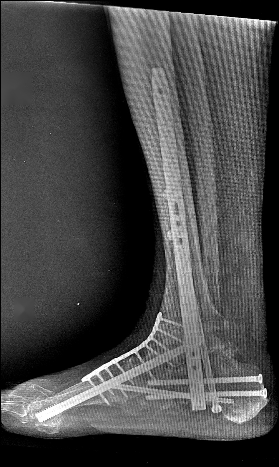 Weight-bearing lateral X-ray after Charcot reconstruction