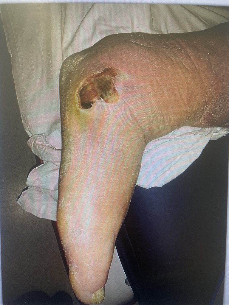 Collapsed Charcot foot with an ulcer under the arch