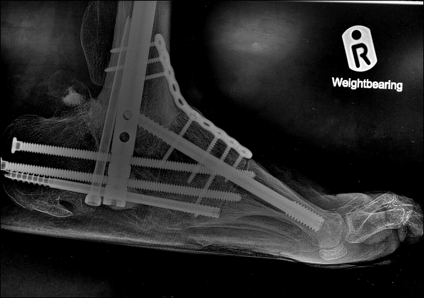 Weight-bearing lateral X-ray of a reconstructed Charcot foot with a medial column beam, plate and screws