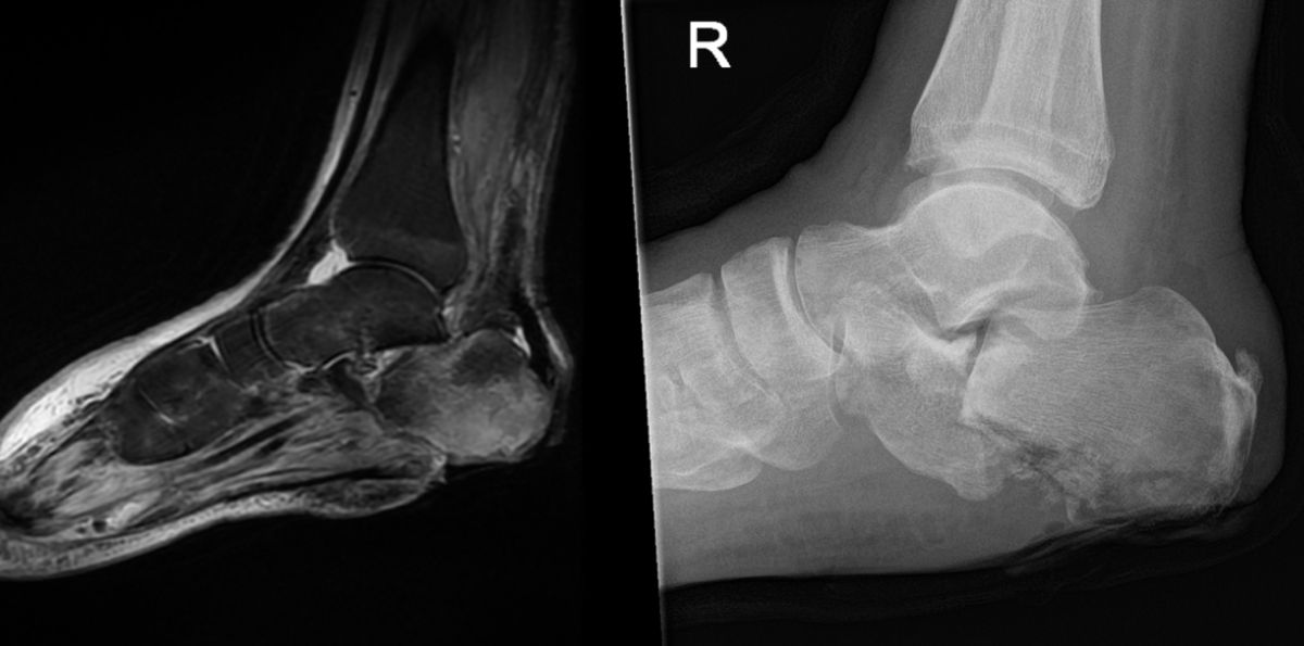 MRI and X-ray of diabetic foot osteomyelitis