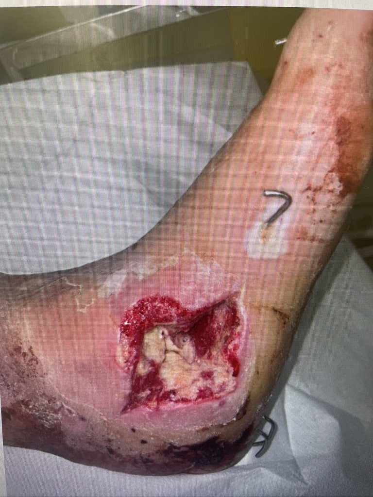 Heel wound with underlying bone infection