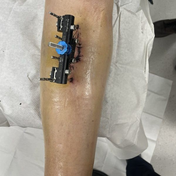 Cybion transverse tibial transport device on the tibia