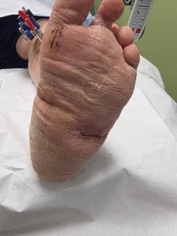 Healed sole after transverse tibial transport