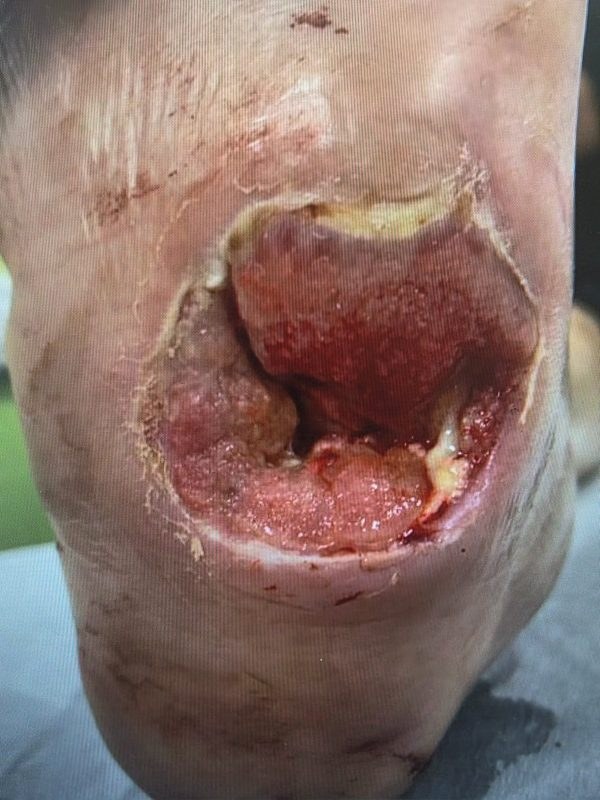 Heel ulceration with necrotic tissue before transverse tibial transport