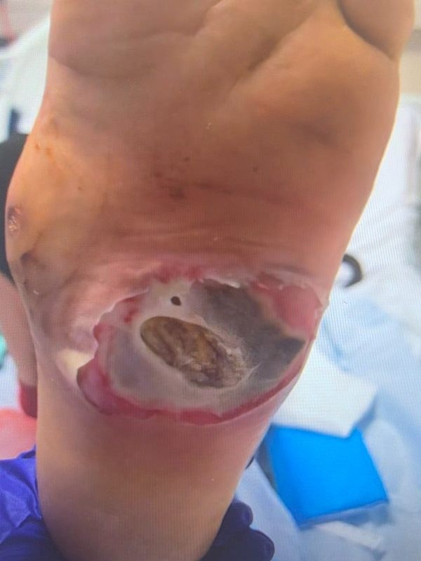 Extensive plantar ulceration before transverse tibial transport